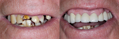 Chipped or Broken Teeth